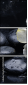 32251345
